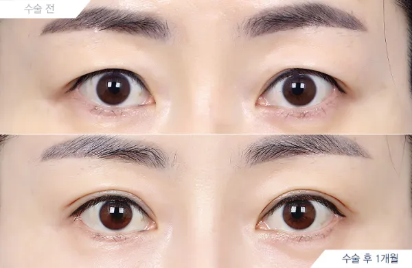 Before/After