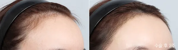 Before/After