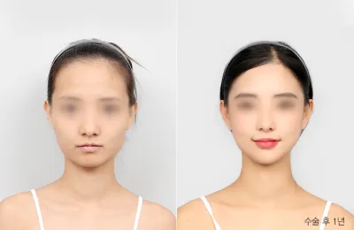 Before & After