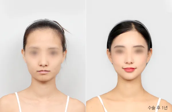 Before/After