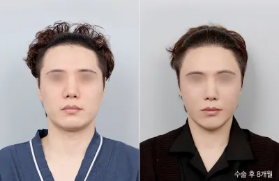 Before & After