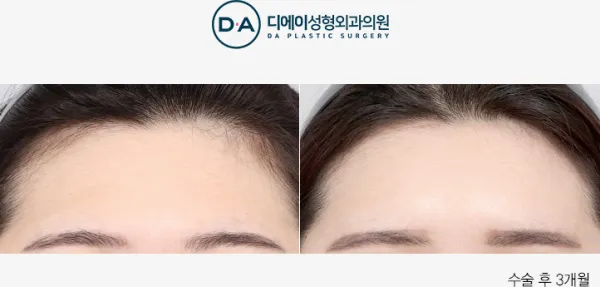 Before/After