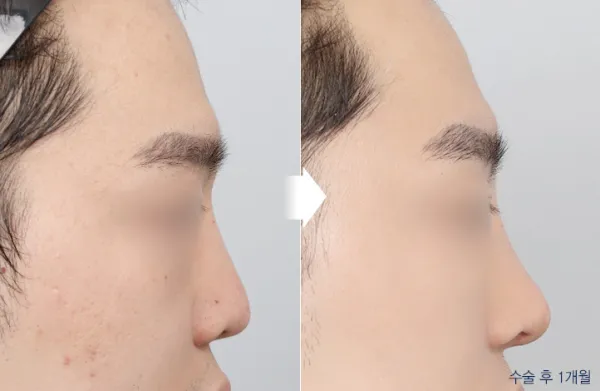 Before/After