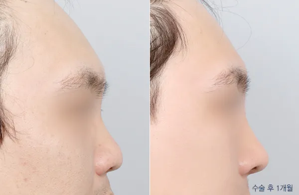 Before/After