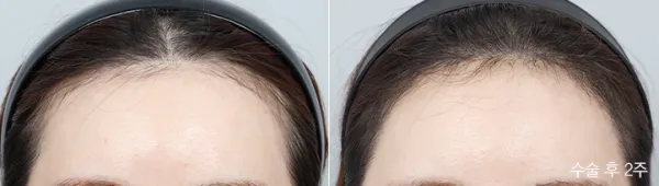 Before/After