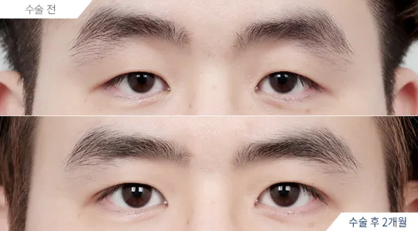 Before/After