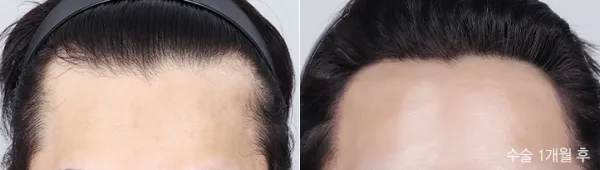 Before/After