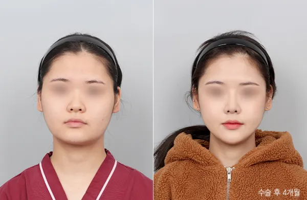 Before/After