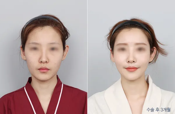 Before/After