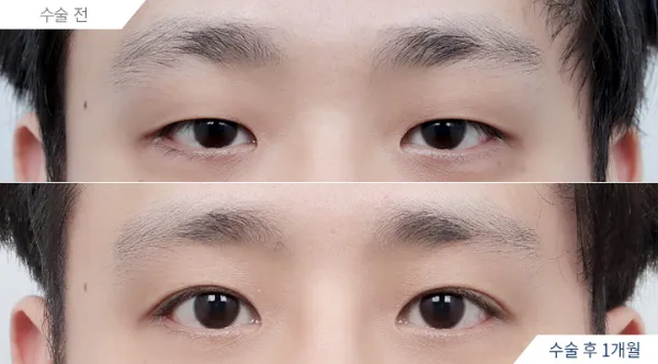 Before/After