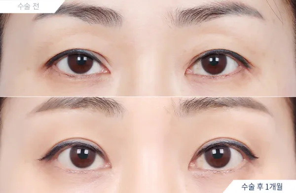 Before/After