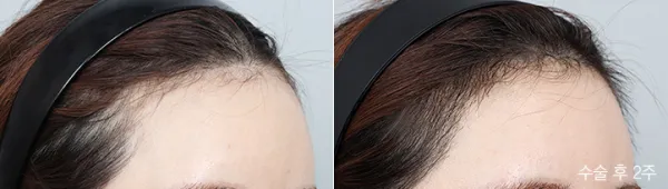 Before/After