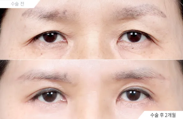 Before/After