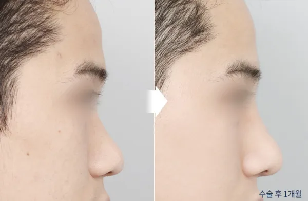 Before/After