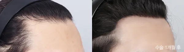 Before/After