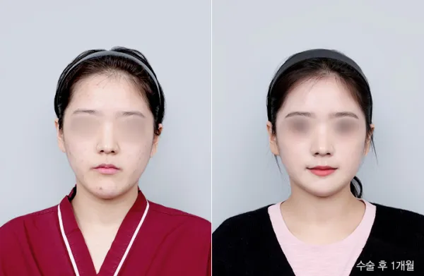 Before/After
