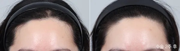 Before/After