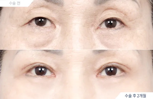 Before/After