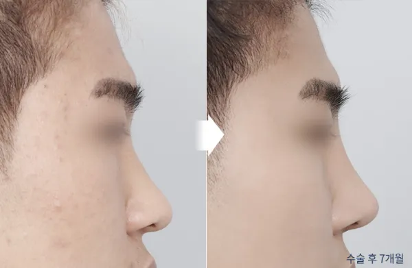 Before/After