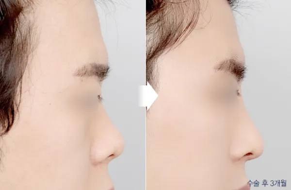 Before/After