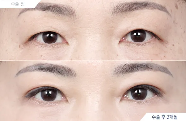 Before/After