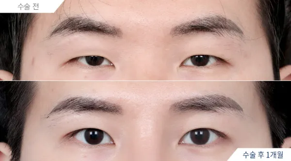 Before/After