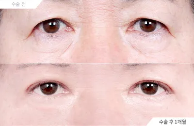 Before & After
