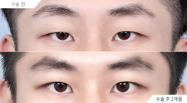 Before/After