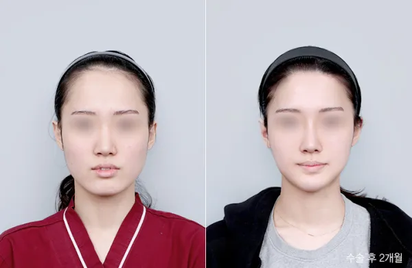 Before/After