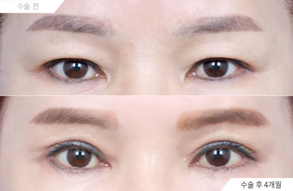 Before/After