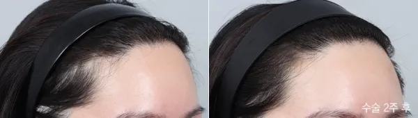 Before/After