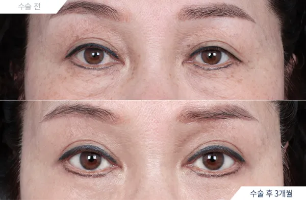 Before/After