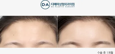 Before & After