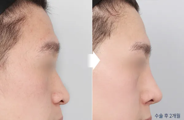 Before/After