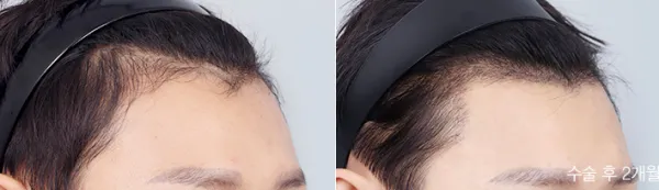 Before/After