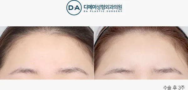 Before/After