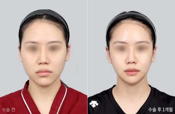 Before/After