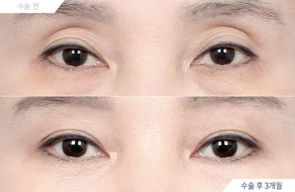 Before/After