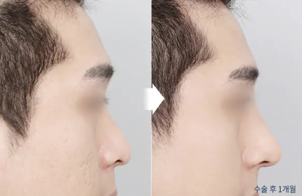 Before/After