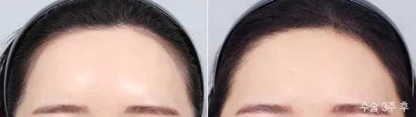 Before/After