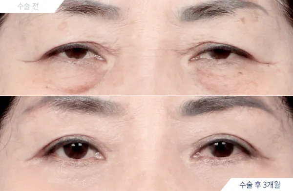Before/After
