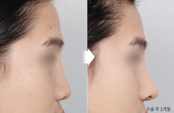 Before/After