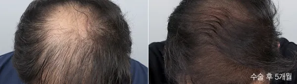 Before/After