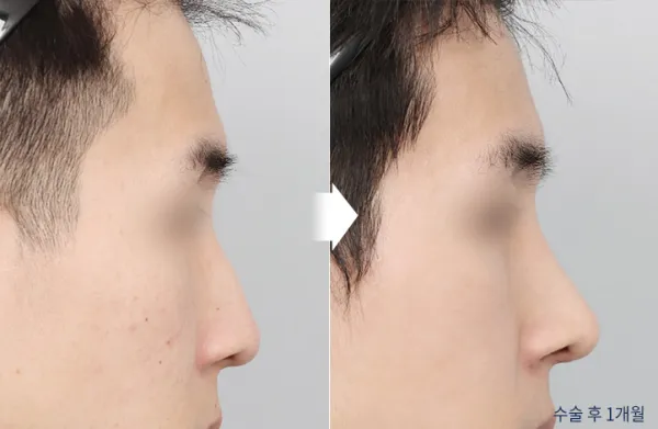 Before/After