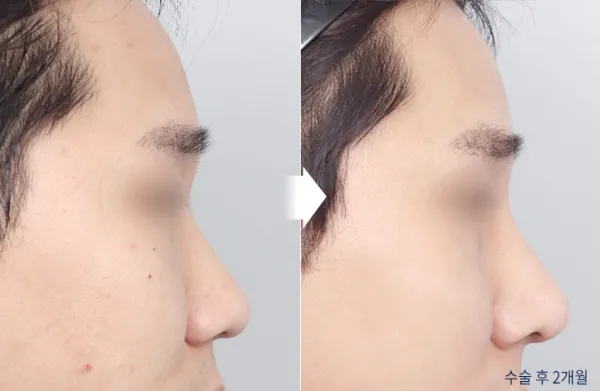 Before/After