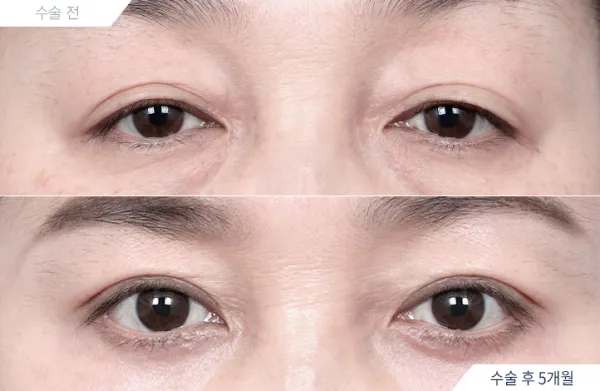 Before/After
