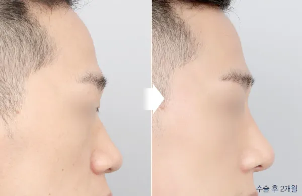 Before/After