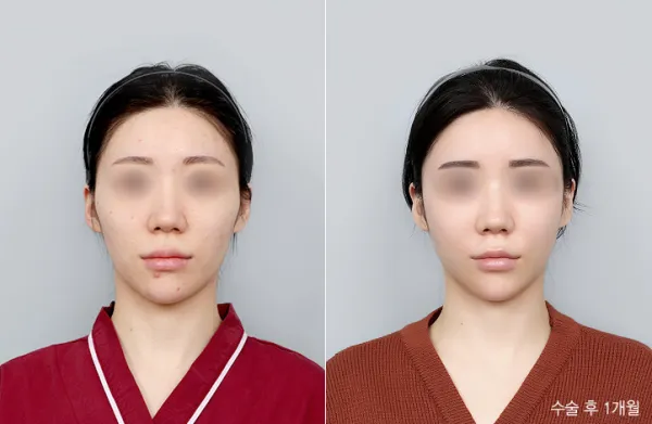 Before/After