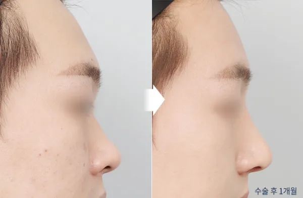 Before/After