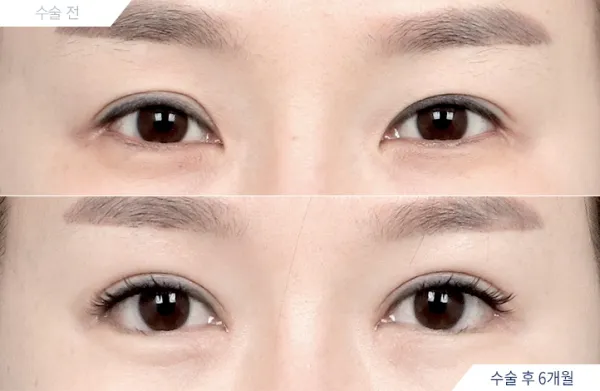 Before/After